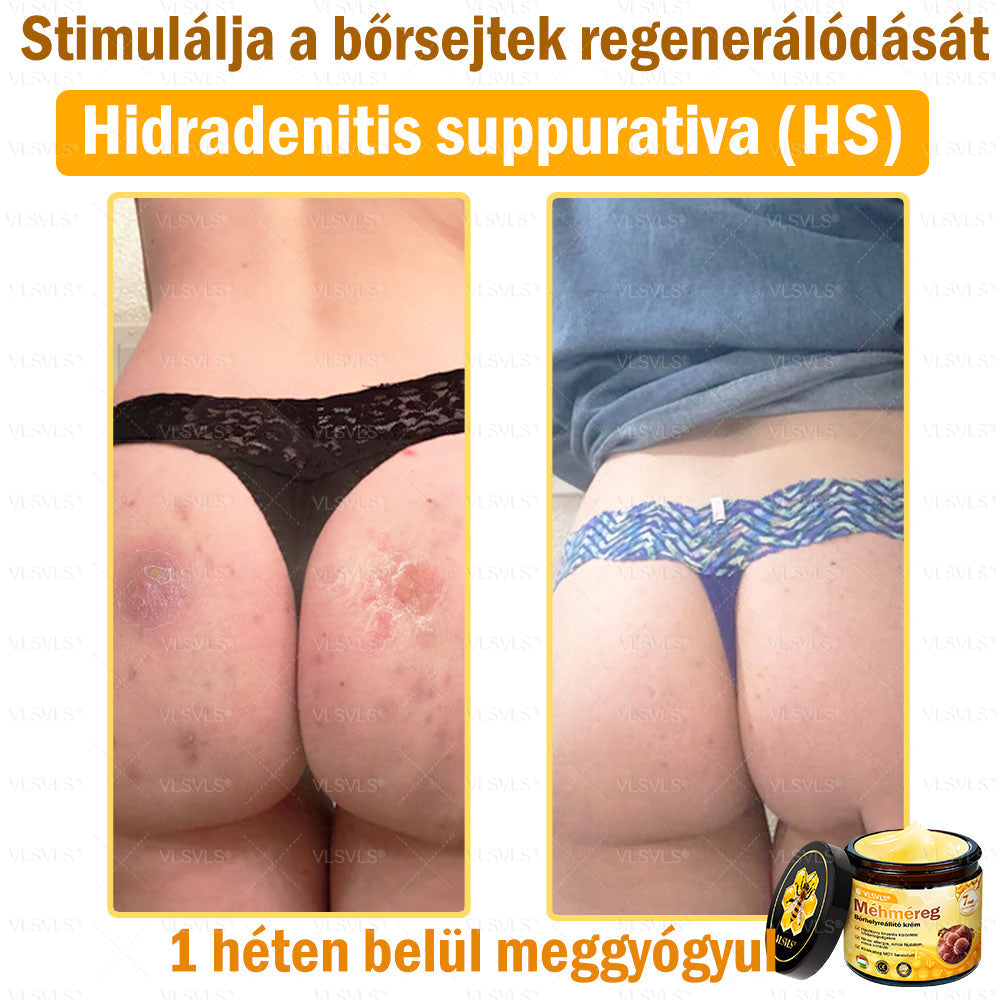 👍💪VLSVLS® Méhméreg Bőrhelyreállító Krém (👨‍⚕‍CE jóváhagyott)✅