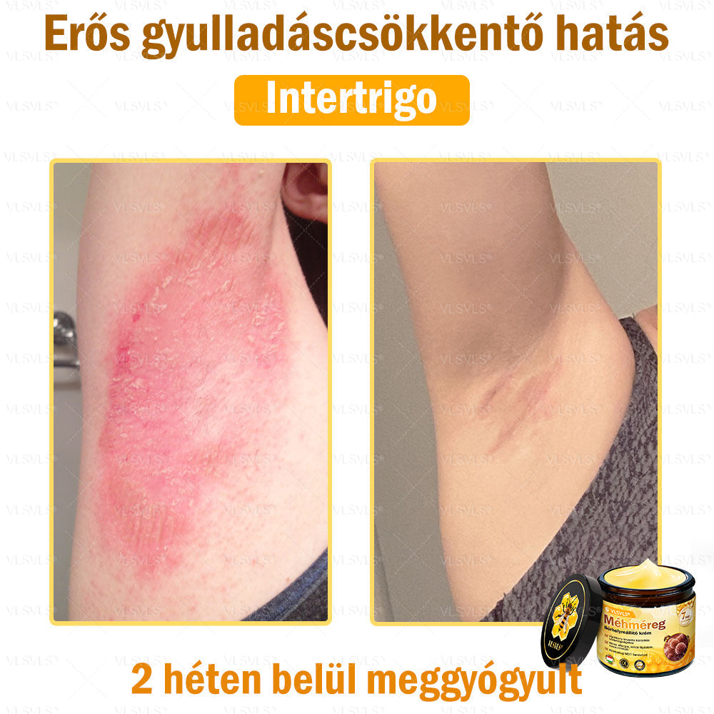👍💪VLSVLS® Méhméreg Bőrhelyreállító Krém (👨‍⚕‍CE jóváhagyott)✅