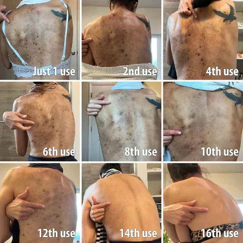 ✨Gyors Sötét Folteltávolító - AQA™ Melanin Korrekciós Arcszérum (🔥Utolsó Napi Akció 60% KEDVEZMÉNY)